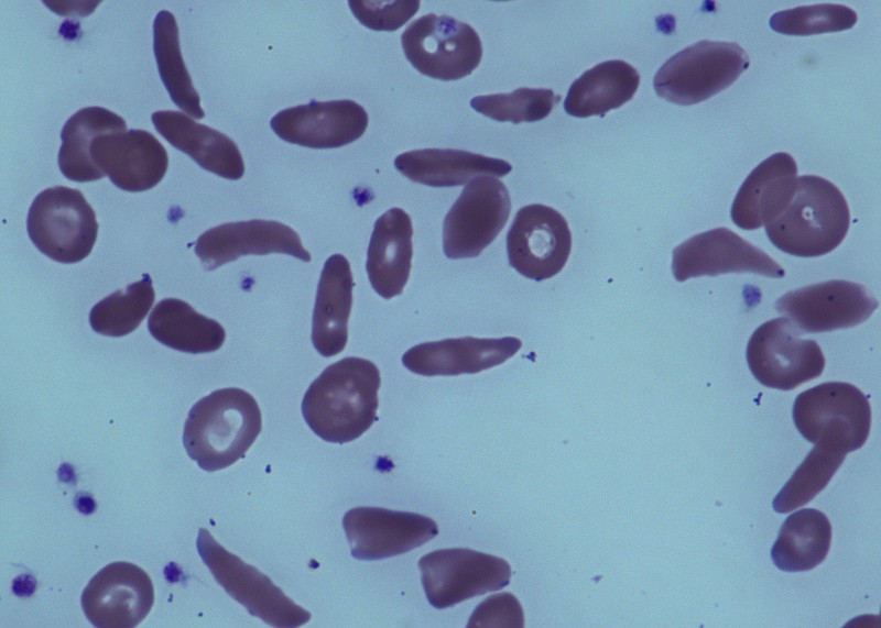 
              This June 2014 image provided by the National Institutes of Health, shows red blood cells in a patient with sickle cell disease at the National Institutes of Health Clinical Center in Bethesda, Md. A small but promising government study by National Institutes of Health found that bone marrow transplants can reverse severe sickle cell disease in adults. Results were published Tuesday, July 1, 2014, in the Journal of the American Medical Association. (AP Photo/National Institutes of Health)
            