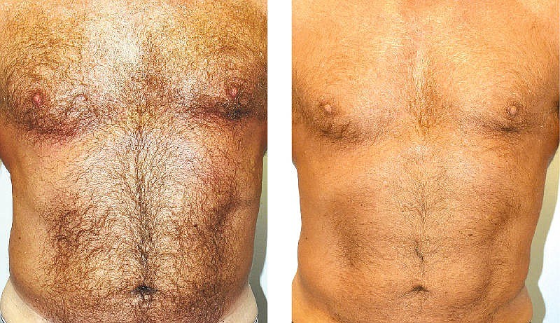 A 61-year old male patient before and after liposculpting, which is basically a more-refined version of liposuction.