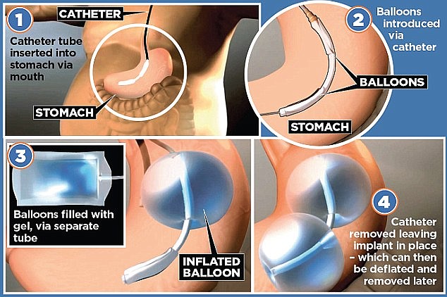Two balloons are actually inserted into the stomach, where they remain for six months.