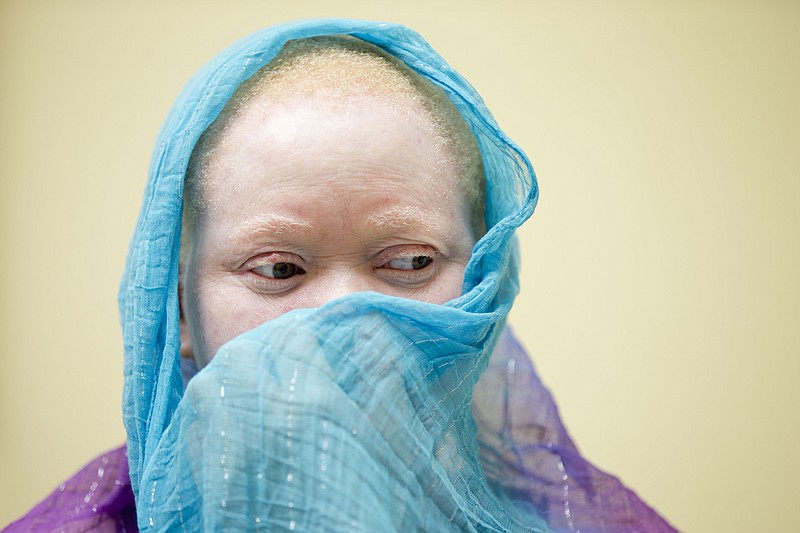 
              Kabula Nkarango Masanja waits during a prosthetic limb fitting, Tuesday, Aug. 25, 2015, at Shriners Hospital for Children in Philadelphia. Kabula and four other children from Tanzania with the hereditary condition of albinism are in the U.S. to receive free surgery and prostheses at the hospital. The children were attacked and dismembered in the belief that their body parts will bring wealth. (AP Photo/Matt Rourke)
            
