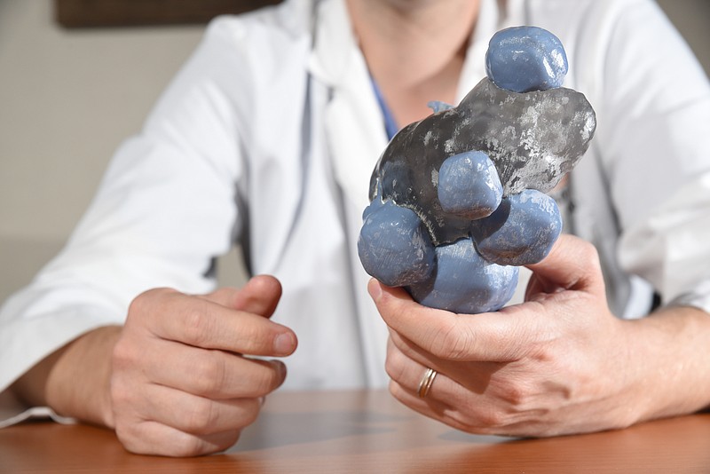 Erlanger Urologist Dr. Chris Keel holds a 3D model of a patient's kidney that he used to prepare for surgery. The blue color represents tumor on the kidney.