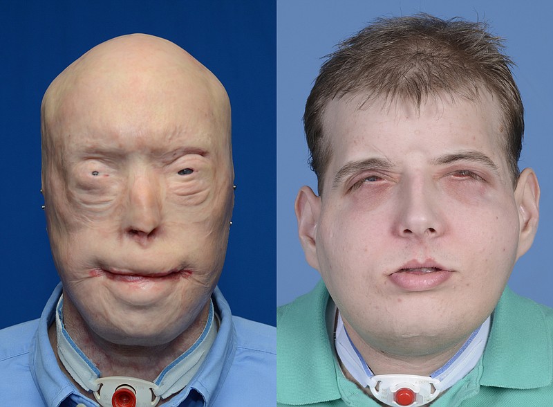 This combination of photos provided by the New York University Langone Medical Center shows Patrick Hardison before and after his facial transplant surgery in New York. Hardison was burned Sept. 5, 2001, in Senatobia, Miss.