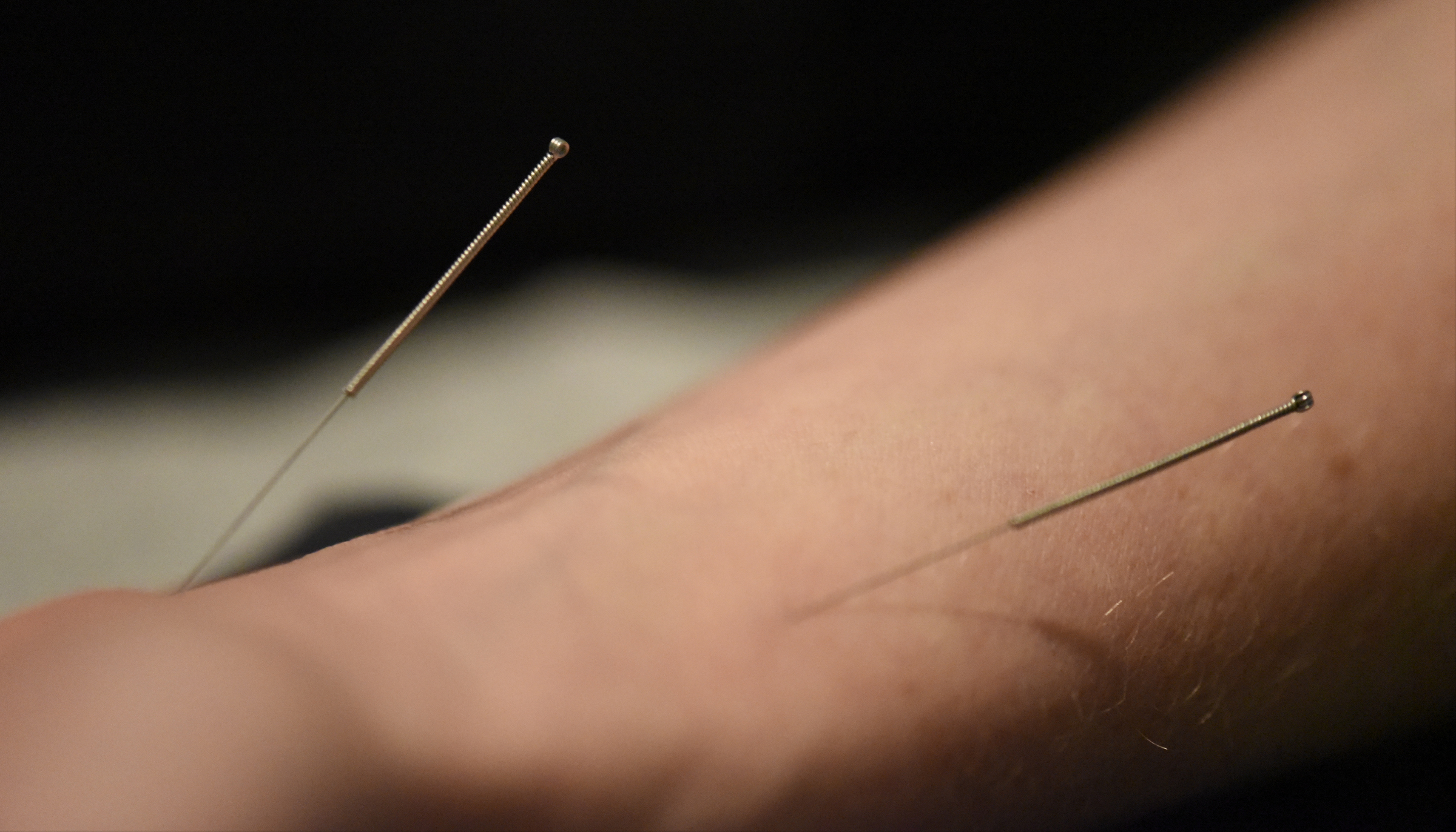 Terra McGill receives an acupuncture treatment at the Yin Yang House Acupuncture and Wellness Center; acupuncture can be used as a treatment for allergies and sinus congestion. / Staff file photo