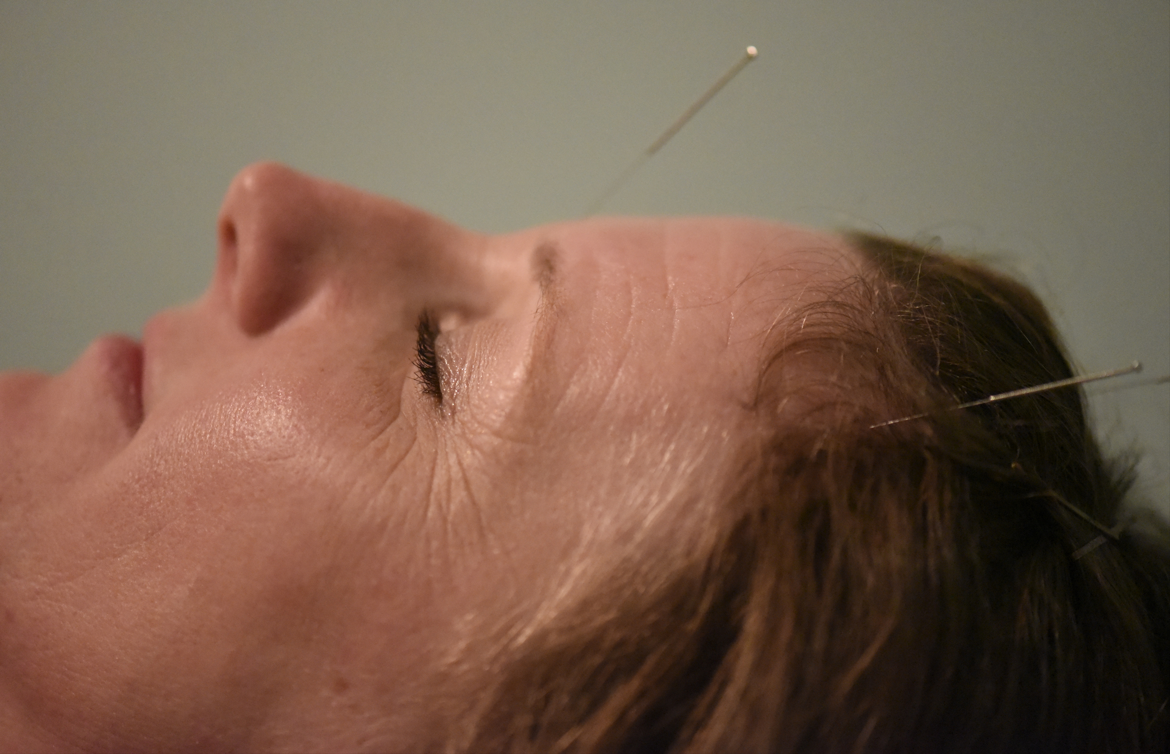 Terra McGill receives an acupuncture treatment at the Yin Yang House Acupuncture and Wellness Center; acupuncture can be used as a treatment for allergies and sinus congestion.