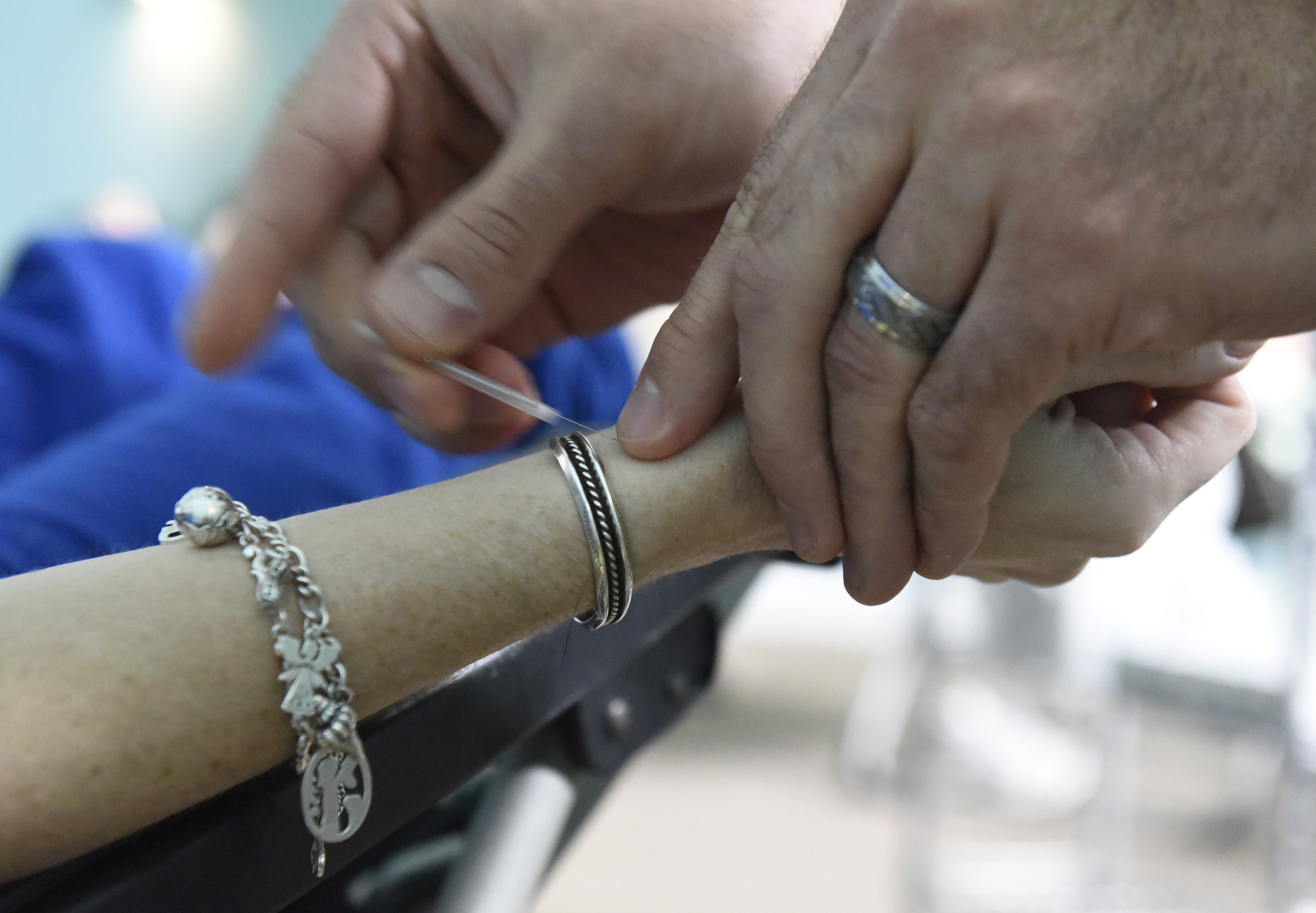 Acupuncturist Chad Dupuis inserts a needle into the wrist of Amanda Cambron at the Yin Yang House on Wednesday, Apr. 6, 2016, in Chattanooga, Tenn. Acupuncture can be used as a treatment for allergies and sinus congestion.