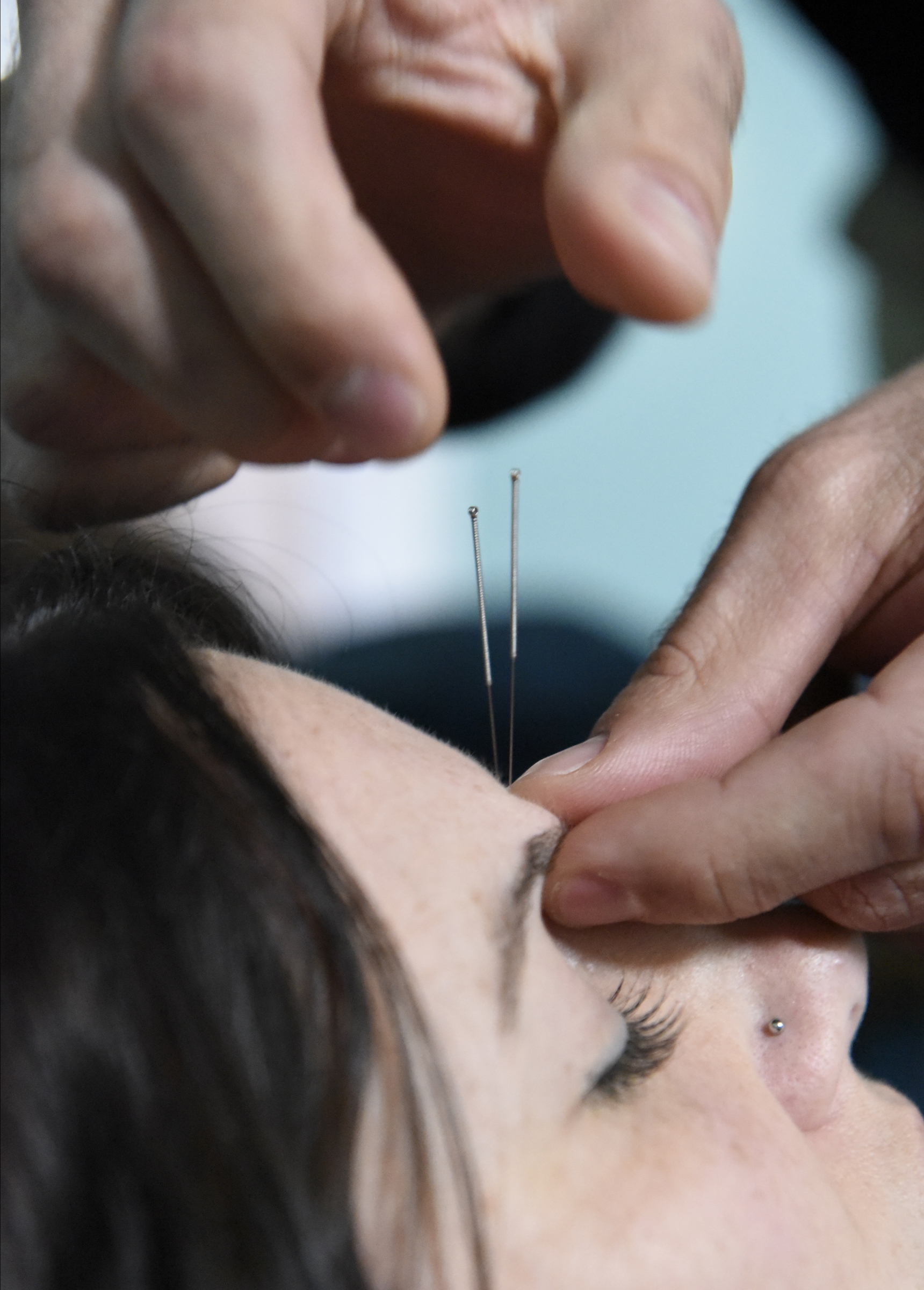 Acupuncturist Chad Dupuis works with Amanda Cambron at the Yin Yang House Acupuncture and Wellness Center; acupuncture can be used as a treatment for allergies and sinus congestion.