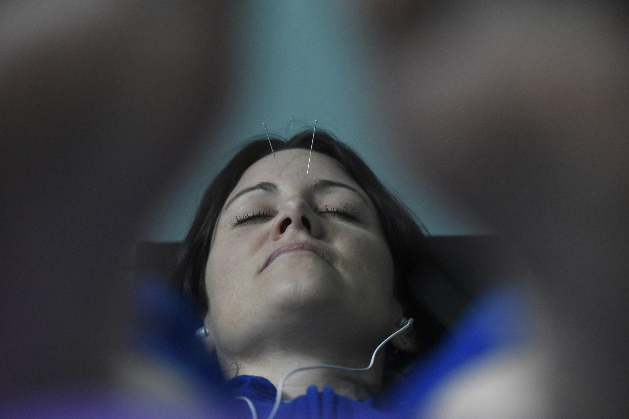 Amanda Cambron listens to music and relaxes as she receives an acupuncture treatment at the Yin Yang House on Wednesday, Apr. 6, 2016, in Chattanooga, Tenn. Acupuncture can be used as a treatment for allergies and sinus congestion.