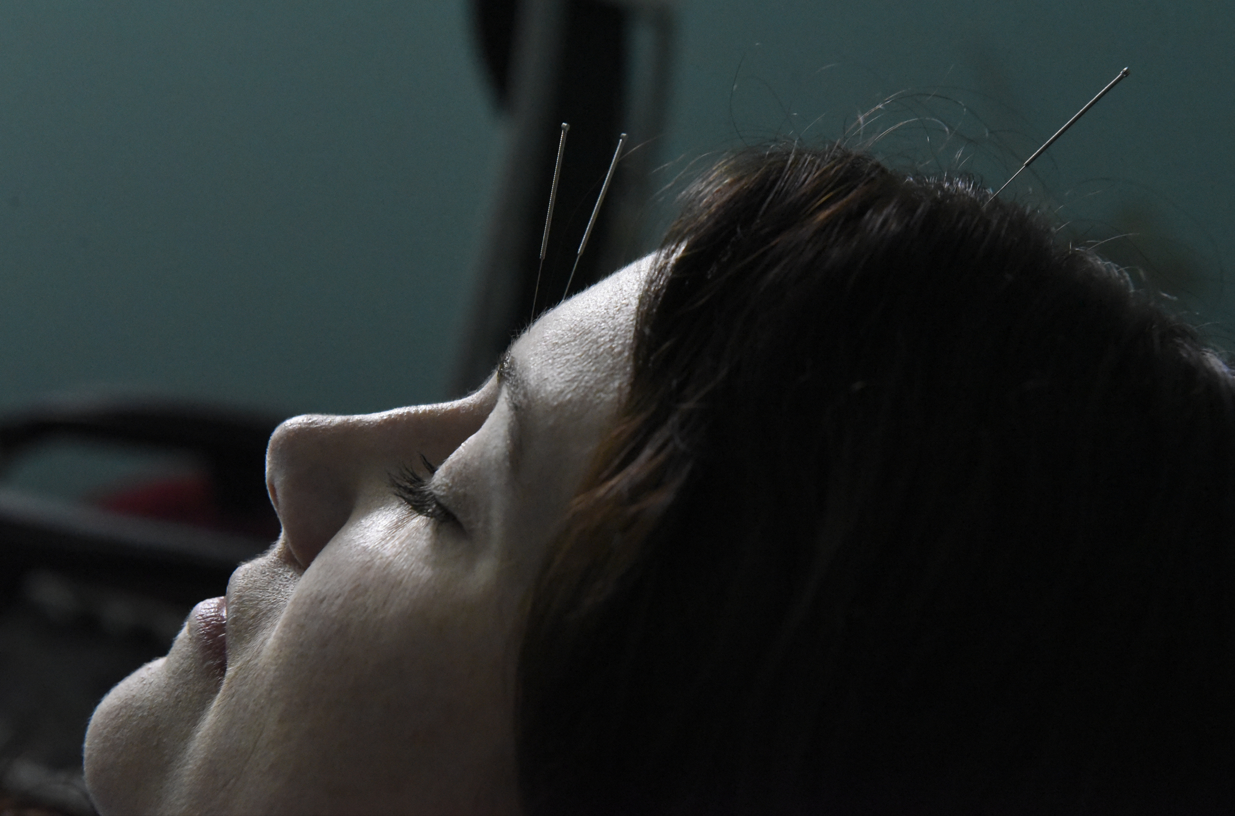 Amanda Cambron receives an acupuncture treatment at the Yin Yang House on Wednesday, Apr. 6, 2016, in Chattanooga, Tenn. Acupuncture can be used as a treatment for allergies and sinus congestion.