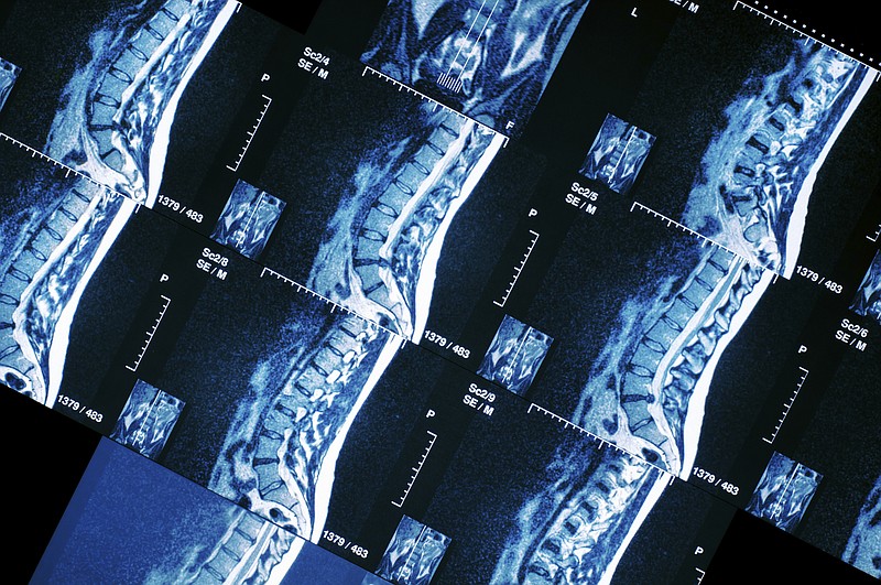 MRI sections of human spine