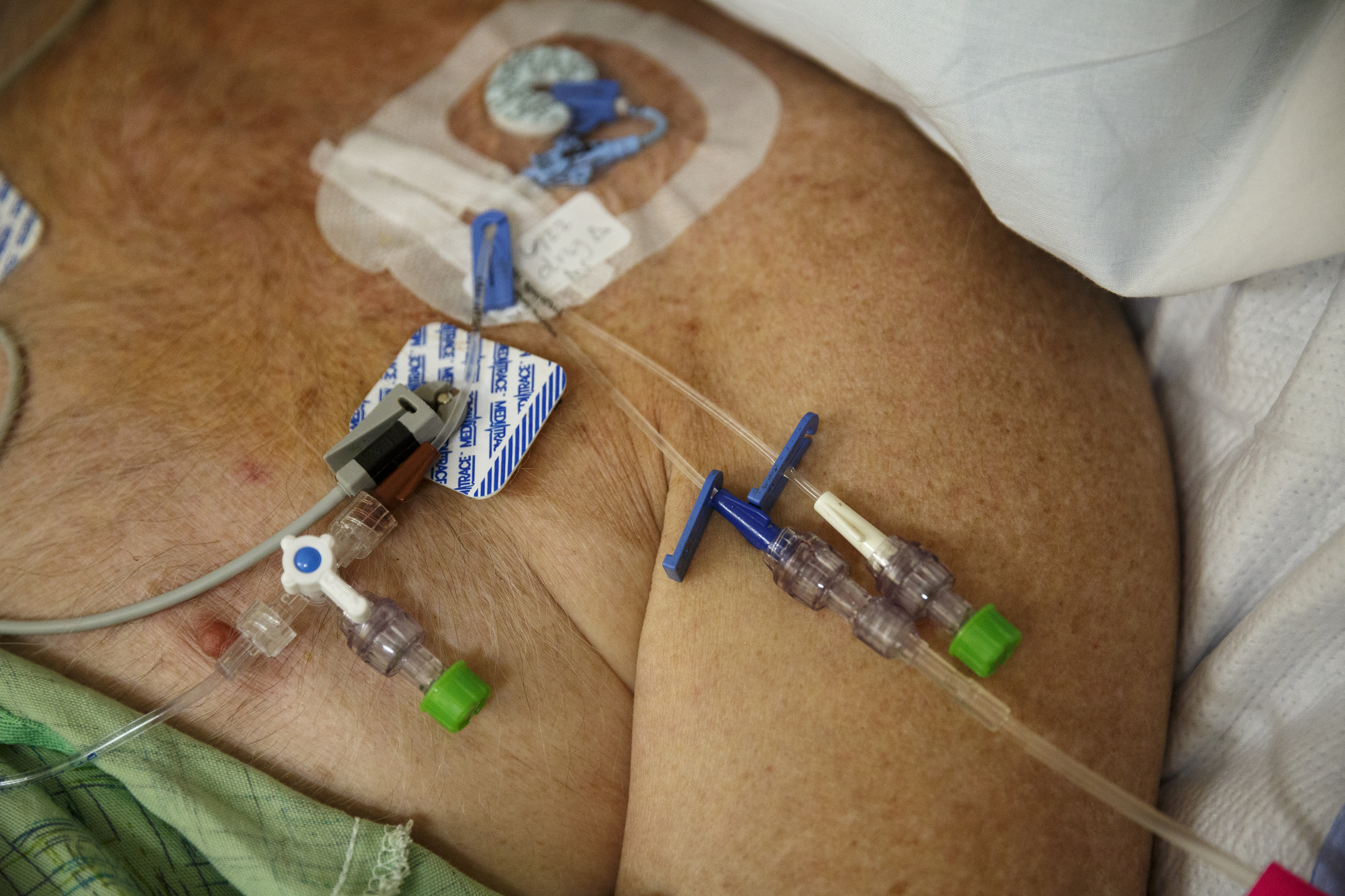 A patient has a central line which is monitored by a team responsible for reducing infection at Erlanger Hospital on Friday, June 24, 2016, in Chattanooga, Tenn.