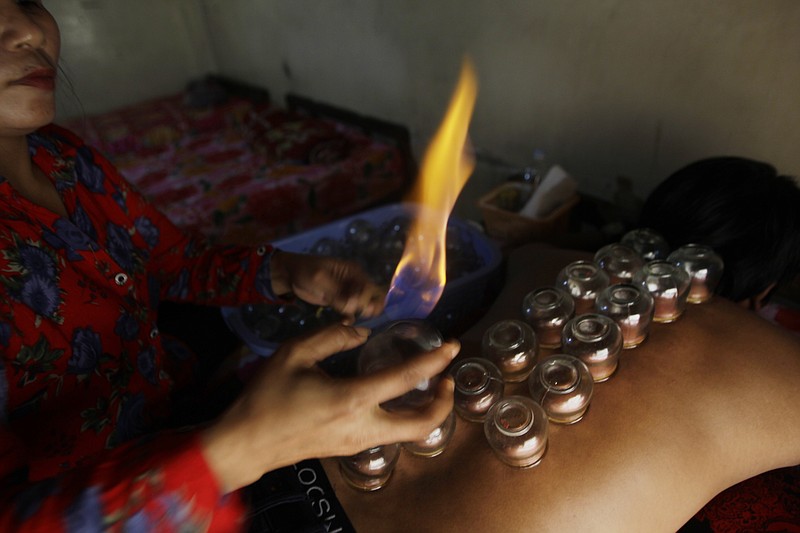
              A Cambodian cupping practitioner prepares the glass cups for treating her costumer at a traditional medicine cupping clinic in Phnom Penh, Cambodia, Wednesday, Aug. 10, 2016. U.S. olympic gold medal winner Michael Phelps made the world aware of cupping by showing his marked muscular shoulders before diving into the pool at the Rio games recently, but cupping, and a similar treatment known as coining, have been practiced in East Asia for centuries. (AP Photo/Heng Sinith)
            