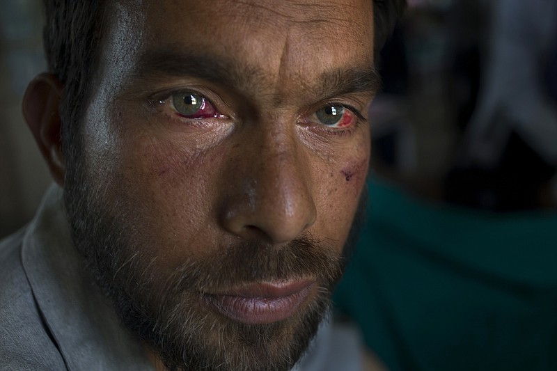 
              Gulzar Ahmed, allegedly beaten up by Indian soldiers who picked him along with several others at Khrew village, recovers at a local hospital in Srinagar, Indian controlled Kashmir, Thursday, Aug. 18, 2016. Residents of Khrew, in Indian-controlled Kashmir, say a young college teacher has been killed while he was in the custody of the Indian army after soldiers picked up dozens of villagers from their homes in the Himalayan region. (AP Photo/Dar Yasin)
            