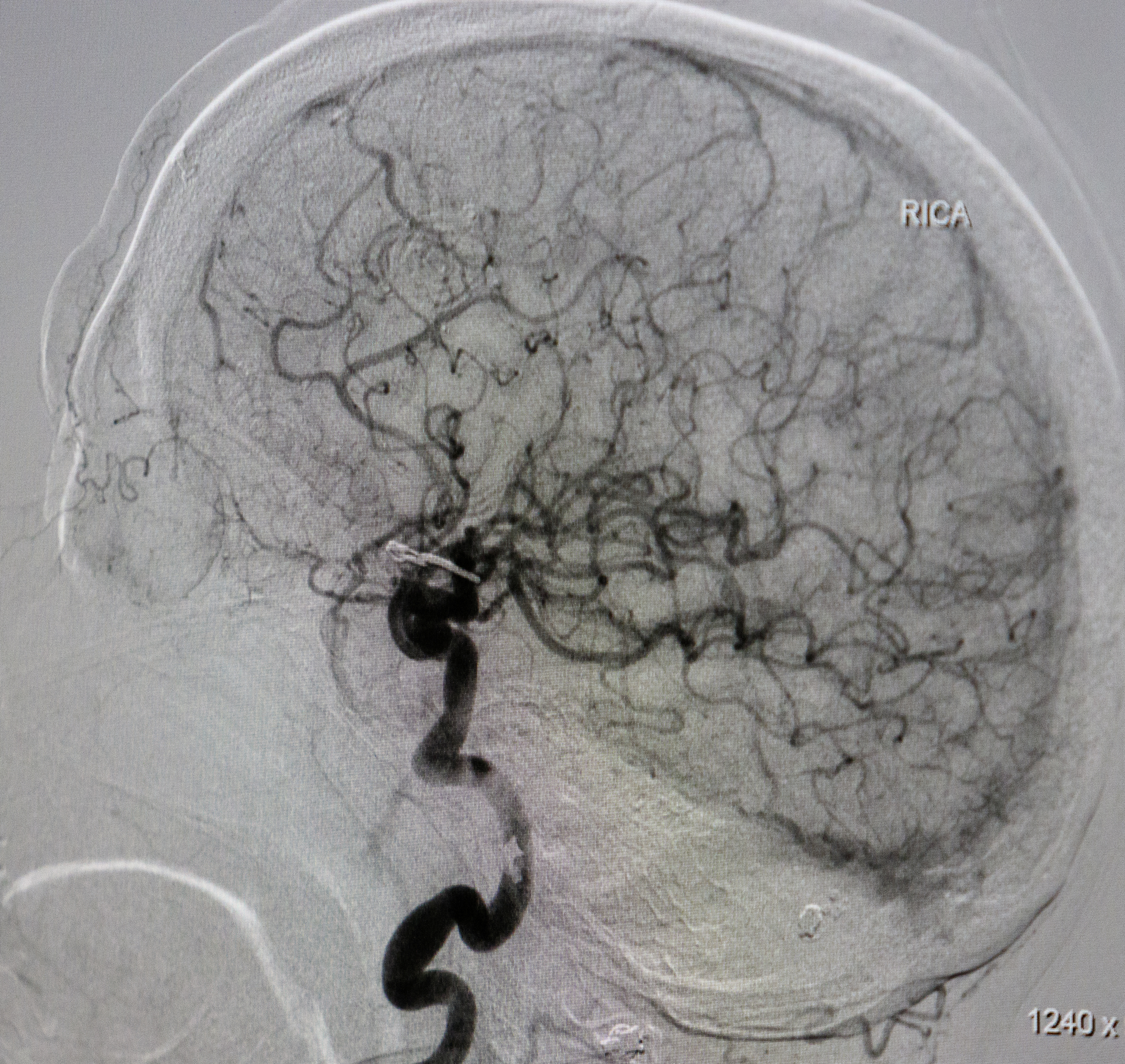 A stroke patient's angiogram is displayed on a screen at Erlanger Hospital on Tuesday, Aug. 23, 2016, in Chattanooga, Tenn. Dr. Devlin is leading a clinical trial involving injecting stem cells into the brains of stroke victims.