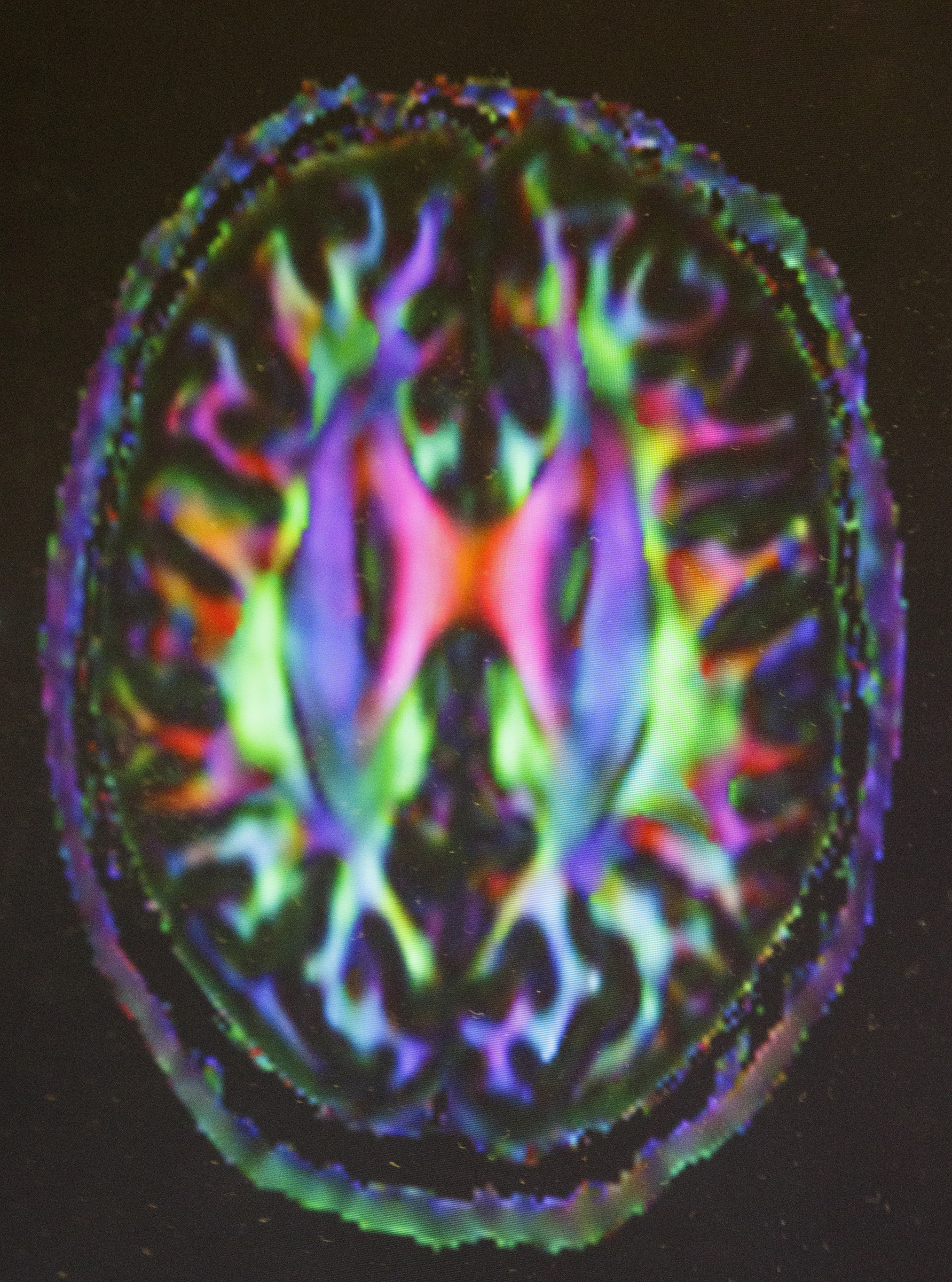 A diffusion MRI scan of a stroke patient's brain is displayed on a screen at Erlanger Hospital on Tuesday, Aug. 23, 2016, in Chattanooga, Tenn. Dr. Devlin is leading a clinical trial involving injecting stem cells into the brains of stroke victims.