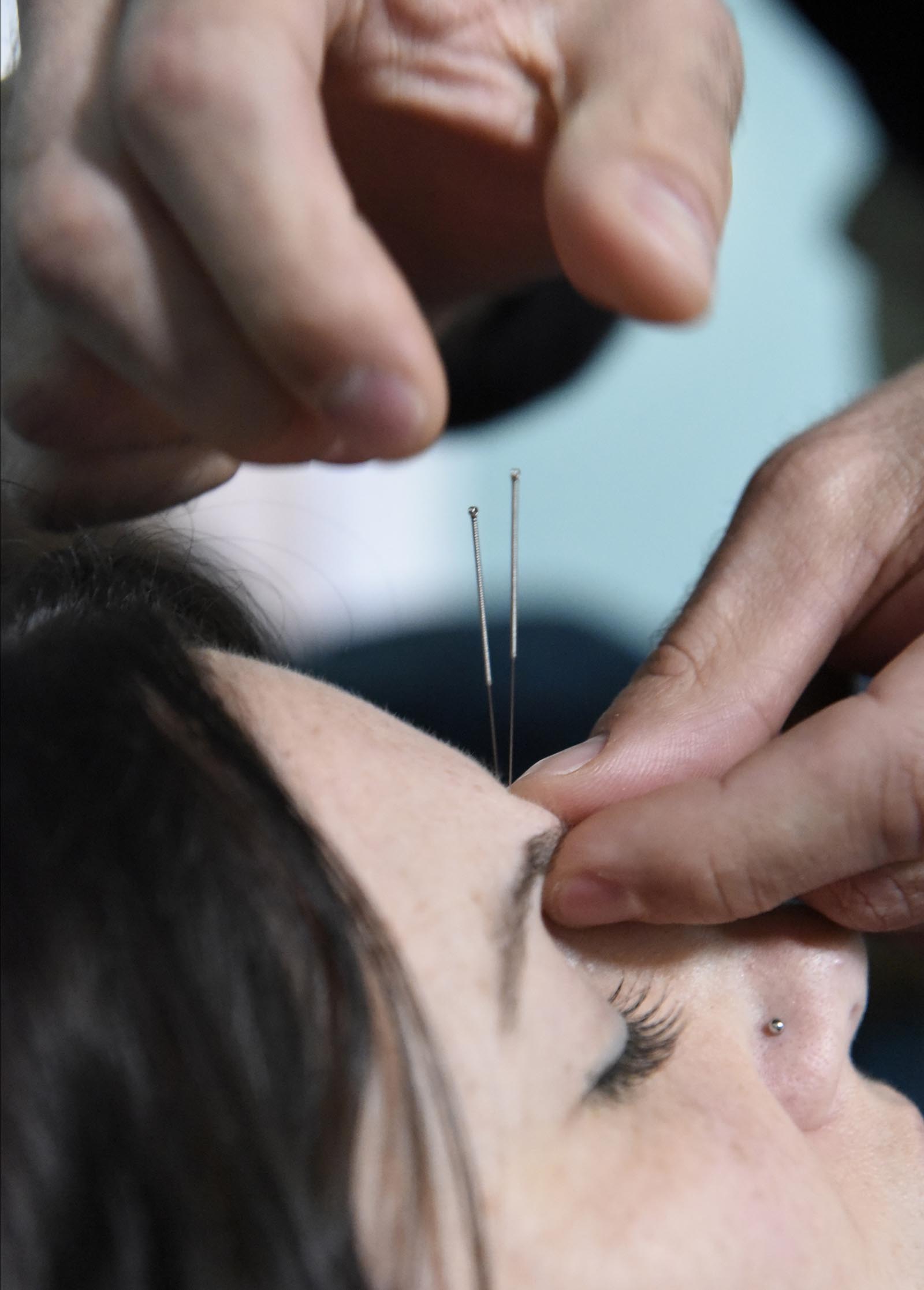Acupuncturist Chad Dupuis works with Amanda Cambron Terra McGill at the Yin Yang House on Wednesday, Apr. 6, 2016, in Chattanooga, Tenn. Acupuncture can be used as a treatment for allergies and sinus congestion.