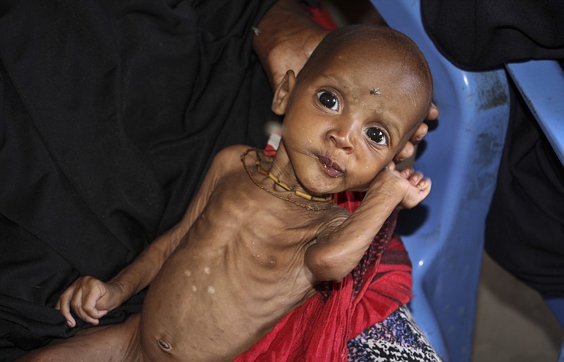 
              In this photo taken Saturday, Feb. 25, 2017, malnourished baby Ali Hassan, 9-months-old,  is held by his mother Fadumo Abdi Ibrahim, who fled the drought in southern Somalia, at a feeding center in a camp in Mogadishu, Somalia. Thousands of desperate people are streaming into Somalia's capital seeking food as a result a prolonged drought, overwhelming local and international aid agencies, while the Somali government warns of a looming famine, compounded by the country's ongoing conflict against Islamic extremists. (AP Photo/Farah Abdi Warsameh)
            