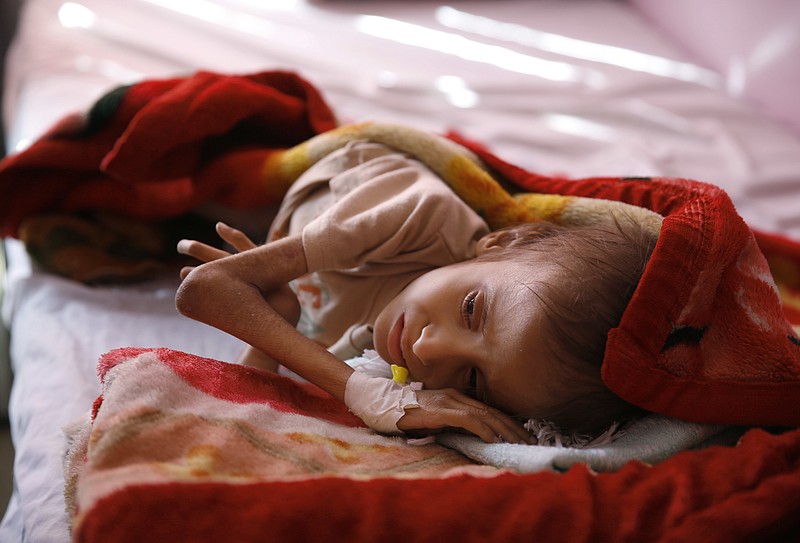 
              FILE -- In this Jan. 24, 2016 file photo, a malnourished child lies in a bed waiting to receive treatment at a therapeutic feeding center in a hospital in Sanaa, Yemen. The U.N. secretary-general and high-ranking government officials from dozens of countries are meeting Tuesday, April 25, 2017, in Geneva to drum up funds for war-torn Yemen. The impoverished Mideast country on the tip of the Arabian Peninsula is considered the world's greatest humanitarian crisis. (AP Photo/Hani Mohammed, File)
            