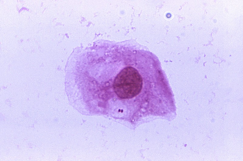 
              This image provided by the Centers for Disease Control and Prevention shows a photomicrograph of Neisseria meningitidis. A contagious bacterial infection appears to be the cause of at least some cases in a mysterious outbreak in Liberia, U.S. health officials said Monday, May 8, 2017. The U.S. CDC tested samples from four of the deceased people and found the bacteria, called Neisseria meningitidis. The bacteria is to blame for a “meningitis belt” in sub-Saharan Africa that passes close to Liberia. (James Volk/Centers for Disease Control and Prevention via AP)
            