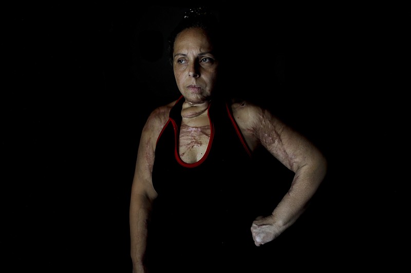 
              In this Feb. 8, 2017 photo, Karina Abregu poses for a portrait in Buenos Aires, Argentina. Abregu was set on fire by her husband, burning 55 percent of her body, and today she continues medical treatment. Abregu suffered years of mistreatment and although she reported 14 incidents over the course of 14 years, police did nothing until two months after the attack. She said the police ignored her calls for help. Police have been stationed outside her home for the past two years because she fears her ex-husband's friends will harm her. (AP Photo/Natacha Pisarenko)
            