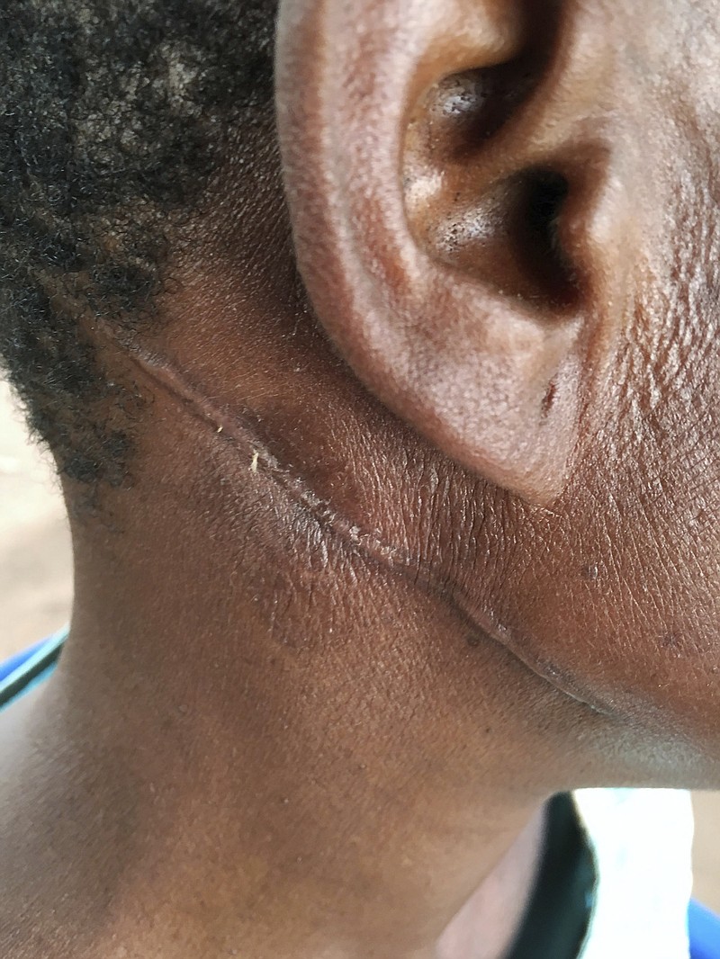
              Undated photo provided by the OHCHR in Geneva, shows a wounded person n the province  Lunda Norte  Angola in June 2017. U.N. human rights investigators have issued a report documenting the killings of more than 250 people, including 62 children, in violence in central Congo over three recent months that could devolve into “wider ethnic cleansing.” The investigators based the report on interviews in June of 96 people who fled Congo’s Kasai provinces into neighboring Angola. (OHCHR via AP)
            