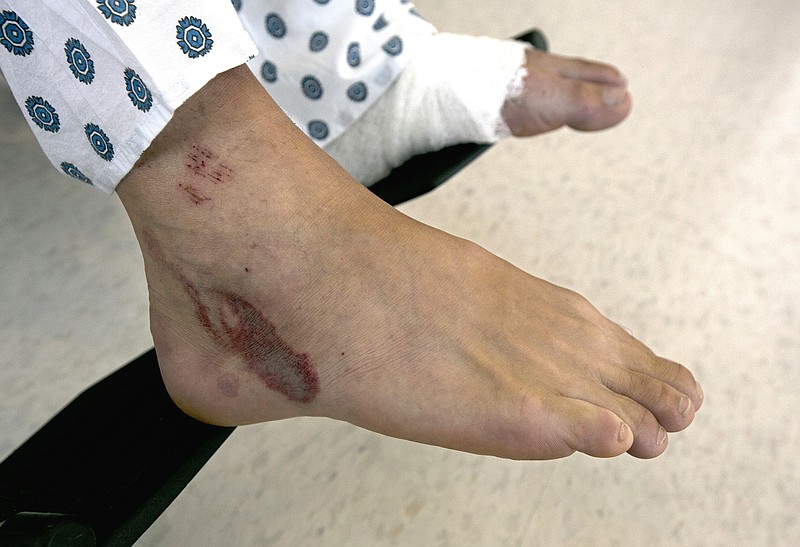 
              Some of the wounds Mathias Steinhuber received from being struck by a lighting bolt are seen on his right foot as he discusses the near-fatal event, Thursday, Aug. 24, 2017, in Sacramento, Calif. His left foot, where the lightning exited his body, is wrapped. Steinhuber, of Innsbruck, Austria, had been hiking the Pacific Crest Trail near Donner Summit Tuesday when he stopped to take a photo and was hit by the lighting. He was taken by helicopter to the the Tahoe Forest Hospital in Truckee, before being flown to the University of California, Davis Hospital Burn Center where he is listed in fair condition. (AP Photo/Rich Pedroncelli)
            