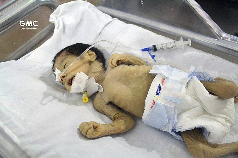 
              This photo provided on Saturday, Oct. 21, 2017 by the Syrian anti-government activist group Ghouta Media Center, which has been authenticated based on its contents and other AP reporting, shows an undernourished infant receiving an IV in an incubator in a hospital in Ghouta, near Damascus, Syria. The United Nations Children agency says the worst malnutrition rate since the start of the Syria conflict nearly seven years ago has been recorded in a rebel-held suburb of Damascus, besieged since mid-2013. (Ghouta Media Center via AP)
            