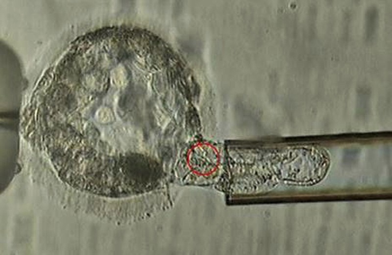 This undated microscope image provided by the American Society for Reproductive Medicine in January 2018 shows a trophectoderm biopsy, in which cells from the outer layer of an embryo that develop into the placenta and amniotic membranes are removed and can be used for genetic testing. When a couple is known to be at risk for having a child with a specific genetic disorder, the woman undergoes a procedure to remove some of her eggs. After fertilization, some cells can be plucked from the embryos and examined to identify those without carry the disease-causing abnormality. (ASRM via AP)Wedn