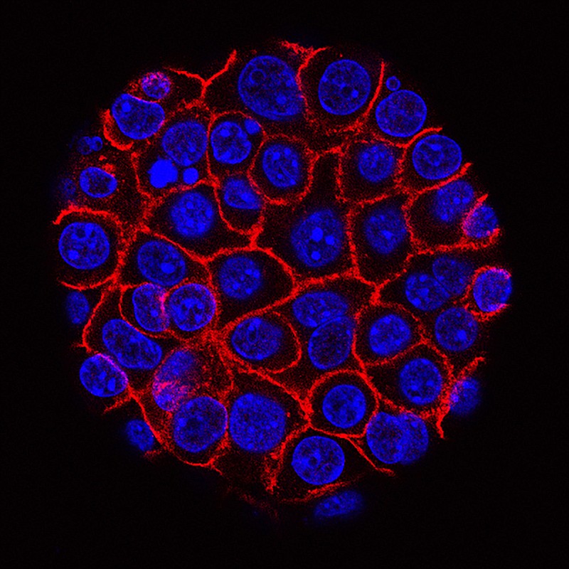 This undated microscope image from USC via the NIH shows pancreatic cancer cells, nuclei in blue, growing as a sphere encased in membranes, red. In a rare triumph for tough-to-beat pancreatic cancer, patients who had surgery lived substantially longer on a four-drug combo than on a standard cancer drug, according to research released on Monday, June 4, 2018. (Min Yu/Eli and Edythe Broad Center for Regenerative Medicine and Stem Cell Research at USC, USC Norris Comprehensive Cancer Center)