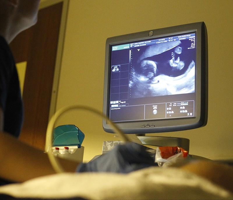 Staff Photo by Doug Strickland /
Ultrasound technician Ashley Durham, left, performs an ultrasound on Courtney Smith, who is pregnant with her first child, on Monday, Jan. 27, 2014, at Galen Medical Group in Chattanooga, Tenn.