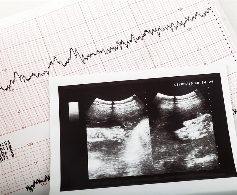 ultrasonic result of the fetus and cardiogram of the baby / Getty Images