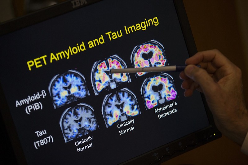 In this May 19, 2015, file photo, a doctor points to PET scan results that are part of a study on Alzheimer's disease at a hospital in Washington. Scientists know that long before the memory problems of Alzheimer's become obvious, people experience more subtle changes in their thinking and judgment. (AP Photo/Evan Vucci, File)
