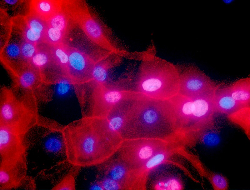 FILE - This undated fluorescence-colored microscope image made available by the National Institutes of Health in September 2016 shows a culture of human breast cancer cells. On Tuesday, Aug. 20, 2019, the U.S. Preventive Services Task Force recommended more women should consider gene testing for hereditary breast or ovarian cancer, especially those who've already survived cancer once. (Ewa Krawczyk/National Cancer Institute via AP)