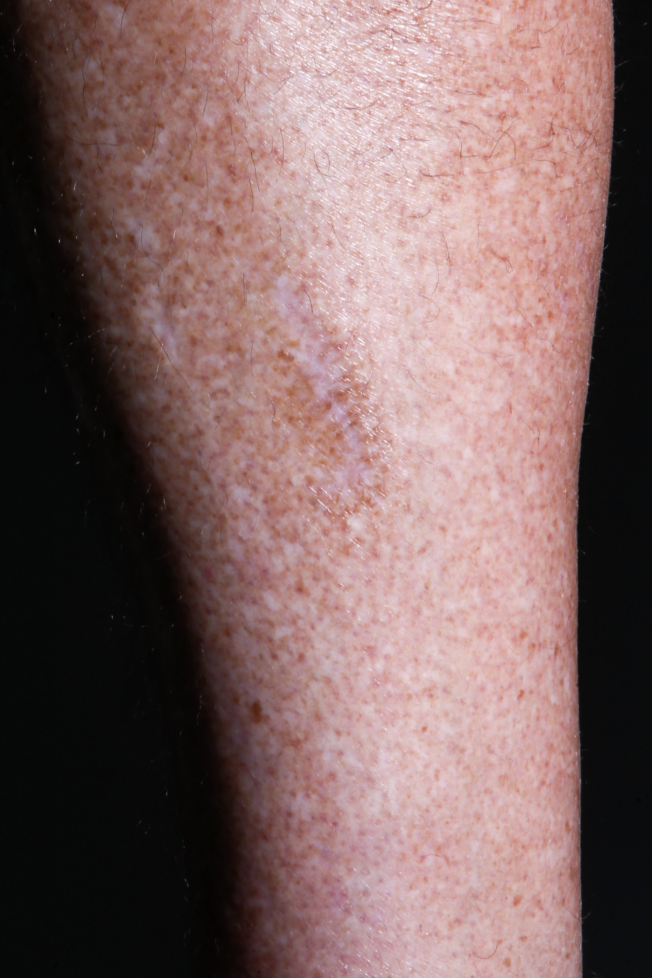 Staff photo by C.B. Schmelter / Billy Collier displays his scar.