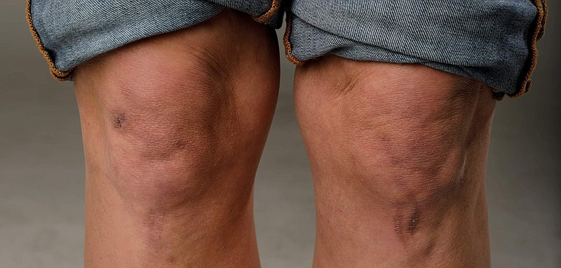 Staff photo by Doug Strickland / Ann-Marie Fitzsimmons has scars on her knees from trail running and a raccoon bite on her right hand.