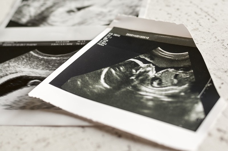 Photographs of ultrasound of pregnancy at 4 weeks and 20 weeks of pregnancy Selective focus.
abortion tile fetus baby / Getty Images