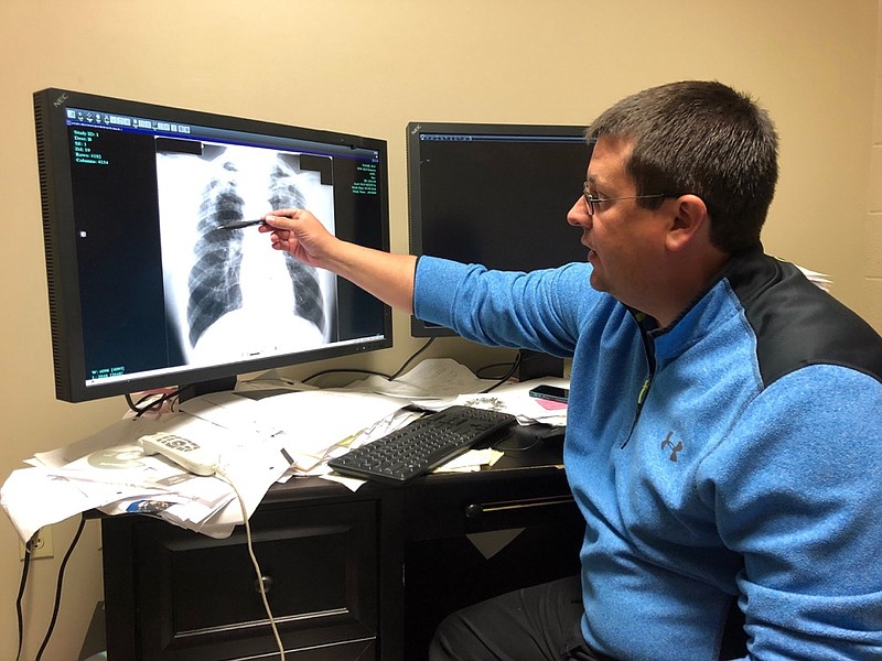 FILE - In this Jan. 24, 2019 file photo Dr. Brandon Crum points to the X-ray of a black lung patient at his office in Pikeville, Ky. (AP Photo/Dylan Lovan, File)


