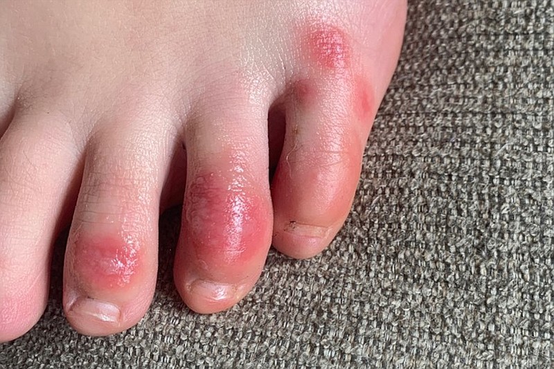This April 3, 2020 photo provided by Northwestern University shows discoloration on a teenage patient's toes at the onset of the condition informally called "COVID toes." The red, sore and sometimes itchy swellings on toes look like chilblains, something doctors normally see on the feet and hands of people who've spent a long time outdoors in the cold. (Courtesy of Dr. Amy Paller/Northwestern University via AP)