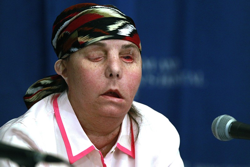 In this May 1, 2013, file photo, Carmen Blandin Tarleton speaks at Brigham and Women's Hospital in Boston following a face transplant. In February 2007 her estranged husband doused her with industrial strength lye, burning more than 80 percent of her body. In July 2020, Tarleton became the first American and only the second person globally to undergo a second face transplant procedure after her first transplant failed. (AP Photo/Charles Krupa, File)