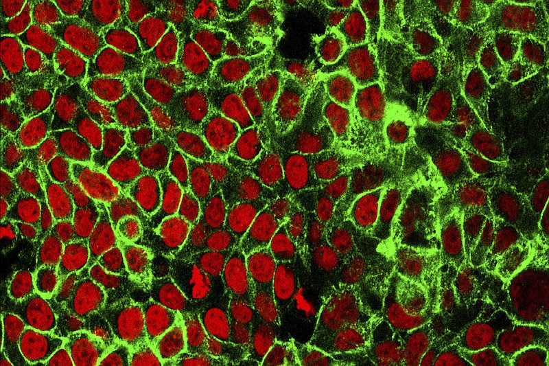 This microscope image made available by the National Cancer Institute Center for Cancer Research in 2015 shows human colon cancer cells with the nuclei stained red. A panel of health experts wants U.S. adults to start getting regular colon cancer screenings at age 45, five years earlier than it now recommends. While overall, colon cancer rates have been declining, the draft guidelines issued Tuesday, Oct. 27, 2020, by the U.S. Preventive Services Task Force reflect a growing concern about rising rates in younger people. (NCI Center for Cancer Research via AP, File)
